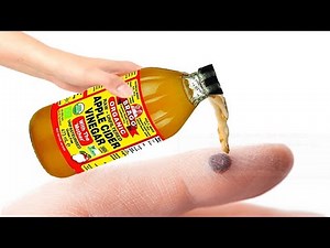 How to Get Rid of Warts Using Apple Cider Vinegar FAST | | Why ACV Works For Warts