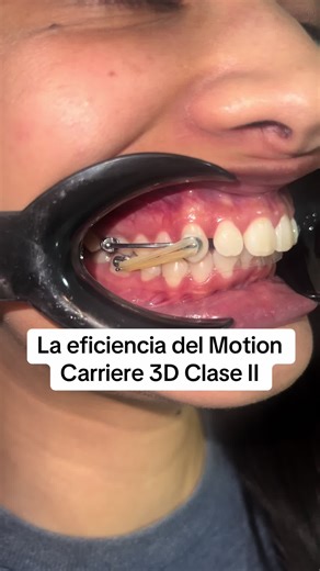 Eficiencia del Motion Carriere 3D Clase II en Ortodoncia