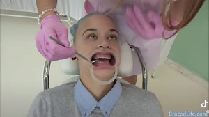 Orthodontic journey begins! #BracedLife #brace #headgear #braces