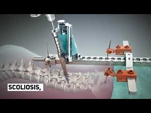 Mazor Robotics - spine surgery