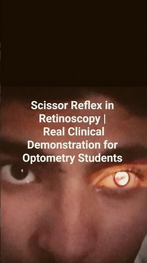 Scissor Reflex in Retinoscopy | Real Clinical Demonstration for Optometry Students