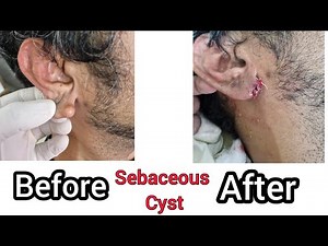Sebaceous Cyst Removal #earloberepair #medicos #dermatology #Cyst #surgerysuccess #viralvideo
