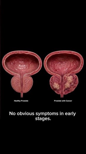 “The Silent Cancer Many Men Never Feel Coming | Prostate Cancer Explained”