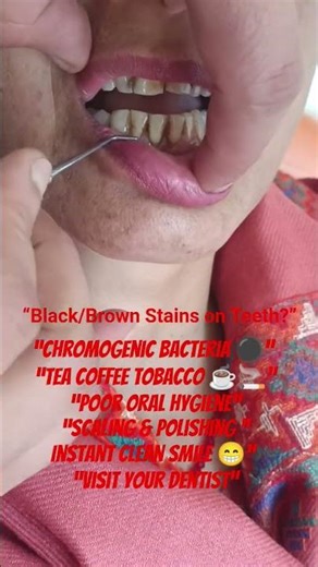 Black/Brown Stains on Teeth?😱Not a Cavity Causes & Treatment Explained#TheDentalGuru #dentist#shorts