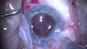 IOL Exchange With Scaffold Technique - Eyetube
