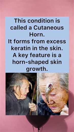 Cutaneous Horn Condition #CutaneousHorn #SkinCondition