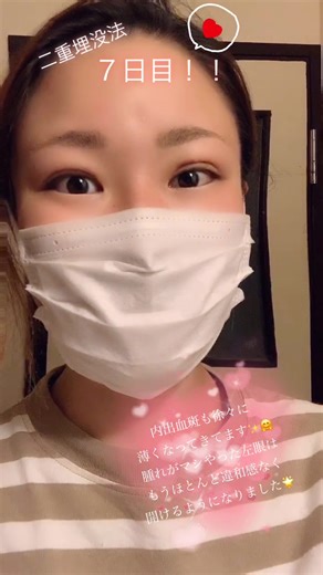 1週間経過！！苦いオフサロン点眼に耐えつつナイスな経過辿ってます🌟😎笑 #二重 #二重整形 #二重埋没 #二重埋没法 #二重埋没経過 #二重埋没観察日記 #看護師 #経過観察 #ダウンタイム