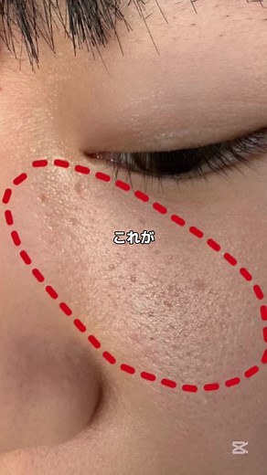 この白いブツブツすごいやだー😂 かといってニキビじゃないから膿が出て治るわけでもなく😇 だけどこの美容液使ったら２週間くらいで手触りも変わるよ✨ お得に試せるリンク貼っといたよ！ #キヌユイ #PR #垢抜け #ピーリング美容液 #KINUI #毛孔性角化症