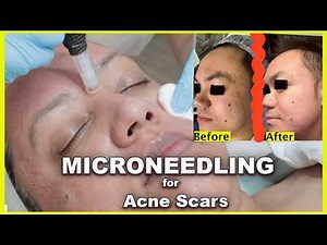 Acne Scars Treatment that show results in 4 weeks - Full Educational Training Video