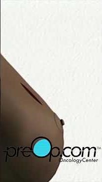 PreOp® Incisional Biopsy Of The Breast