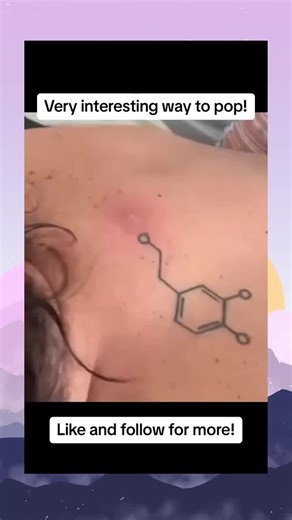 Satisfying Pimple Acne Extractions | Oddly Satisfying Video