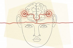 Scientists may have the key to treating tinnitus: Retrain the brain