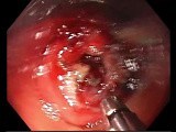 Control of Vessel Bleeding During ESD • Video • MEDtube.net