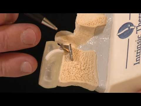 Rezidivierende Bandscheibenvorfälle