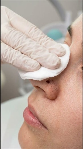 Extration Acne on face