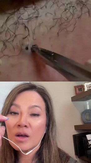 Ingrown Hair Removal Techniques by Dr. Pimple Popper