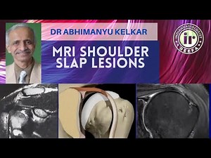 DR ABHIMANYU KELKAR | SLAP LESIONS | MRI SHOULDER