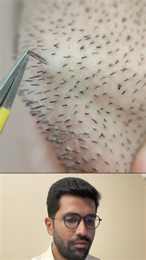 Three Follicles… One Clean Removal