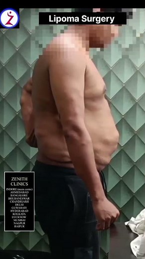 Lipoma Surgery In Raipur | Lipoma Removal Surgery Raipur | Lipoma Surgery