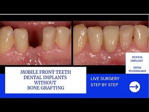 Dental Implant - lower front teeth