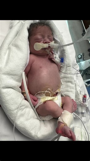 Luka’s Story 🤍 A Journey of Strength, Faith, and Miracles Luka is a true miracle and a living testament to strength, perseverance, and hope. He is a NICU warrior who has already faced challenges most never will—and he continues to surprise everyone who meets him. Luka was intubated at birth and diagnosed with a Grade 4 brain bleed, one of the most severe forms. At just 6 days old, he developed hydrocephalus, a life-threatening condition where fluid builds up in the brain. Because of how critica