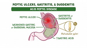 Video: Peptic ulcers, gastritis, and duodenitis (pediatrics): Clinical sciences - Video Explanation! | Osmosis | Osmosis