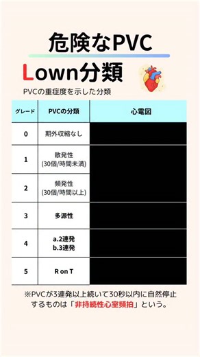 ミカタl1日2分で理解デキる医療の知識 on Instagram: "最後にプレゼントがあるよ🎁 Lown分類を簡単に説明。 このアカウントでは医療の知識を毎日2分で積み上げる！ストーリーでは毎日一枚まとめを共有中です。一緒に学びましょう😊 @ce.mikata 0：期外収縮なし 内容：心室性期外収縮（PVC）を認めない。 意味合い：不整脈としてのPVCはみられない状態。 グレード1：単発で少ない PVC 内容： 単形性 PVC（形が同じ） 頻度は 1時間あたり30発未満（教科書により表現差あり） ポイント： 「たまに単発で出ているだけ」というイメージ。 器質的心疾患がなければ、予後は比較的良好とされることが多い。 グレード2：単発だが頻発 PVC 内容： 単形性 PVC 1時間に30発以上 など、グレード1より頻度が多い ポイント： 「単発PVCがかなり多い」状態。 頻度が多くなるほど、基礎心疾患の有無や心機能をしっかり評価すべき。 グレード3：多源性 PVC（多形性 PVC） 内容： 形の異なる PVC が複数種類みられる（多源性／多形性）。 ポイント： 異なる起源から PVC