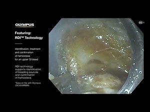 Identify Bleeding Points with RDI™ Technology