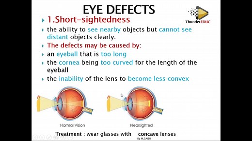 EYE DEFECTS & THEIR correction _ grade 12 life sciences _ ThunderEDUC _ M.SAIDI