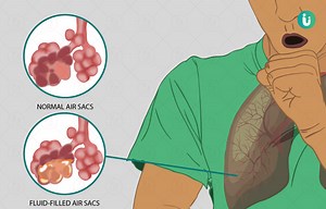 निमोनिया के लक्षण, कारण, इलाज, दवा और उपचार - Nimoniya (Pneumonia) Ke Karan, Lakshan, ilaj, Dawa Aur Upchar in Hindi