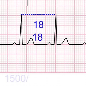2.4K views · 57 reactions | How to Calculate Heart-Rate from ECG -...