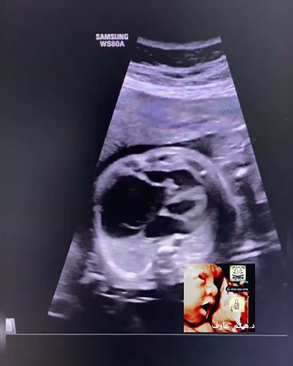 Ebstein Anomaly fetal echo by Dr.Haissam Aref, DMS, MSc, MD ultrasound