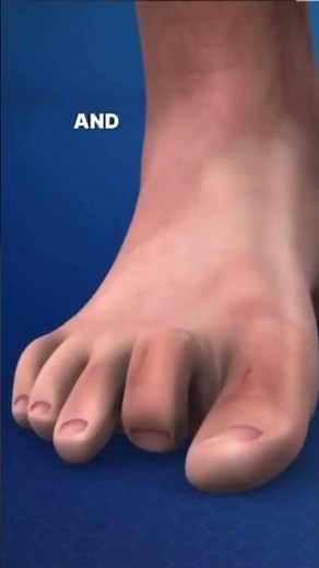 What is Claw Toe?