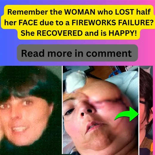 A woman in Sugar Land, Texas, suffered a devastating injury when a fireworks accident caused severe damage to half of her face. She was life-flighted to the hospital with extensive facial injuries after tripping while lighting fireworks, which then exploded near her face. Witnesses described the injury as involving half of her face. Despite the severe trauma, the woman has undergone medical treatment and recovery. The incident highlights the dangerous nature of fireworks and the importance of sa