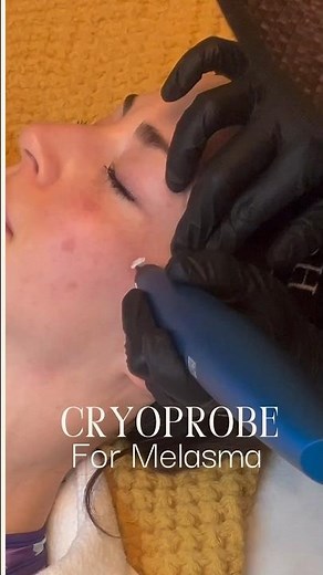 Cryoprobe pen for Melasma spots removal. Before and after video and photos #cryoprobe #melasma