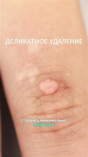 Бородавка на пальце ребёнка: до и сразу после удаления