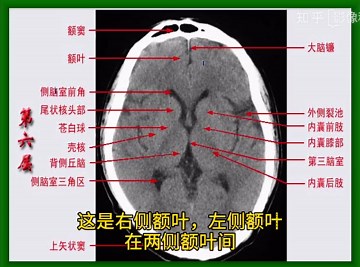 颅脑CT解剖（三）：基底节层面解剖识别