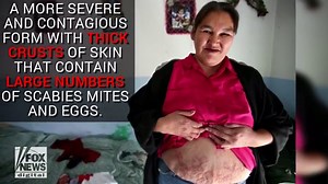 Scabies: Get to know the symptoms and treatments