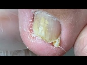 Curved nail “stabs” into toe! Carefully remove it