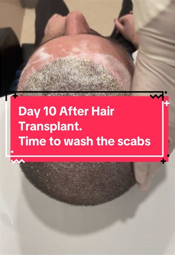 How to Remove Scabs After Hair Transplant: Step-by-Step
