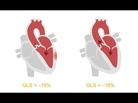 Analyzing ventricular dysfunction with the help of strain imaging echocardiography