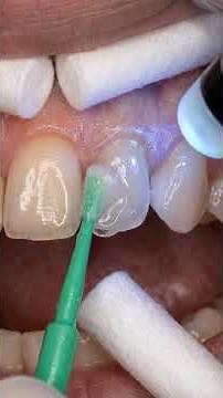Fixing a Pointy Peg Lateral Front Tooth Instantly