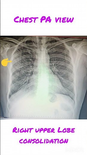 Chest PA view With right upper lobe consolidation #motivation #medical #radiology #facts #shorts