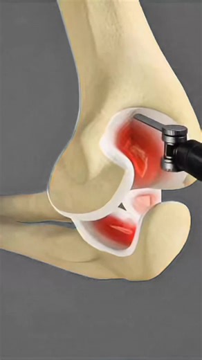 Elbow Joint Transplant 😱 | How Doctors Replace a Damaged Elbow & Restore Movement (3D Animation) #elbowjointtransplant #elbowsurgery #jointreplacement #orthopedicsurgery #medicalprocedure