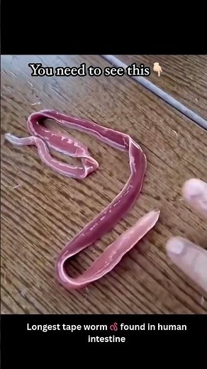 Longest tape worm 🪱 found in human intestine || 7starmedilink