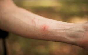 Prevention is better than cure when it comes to insect bites