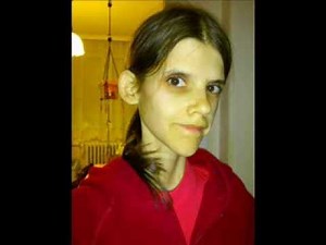 My recovery story from anorexia