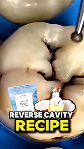 CultivateElevate on Instagram: "Reversing a cavity? Simple. Organic Coconut oil + Pearl powder + 1 drop organic clove. Brush, rinse, pull, and repeat. https://cultivateelevate.com/search.php?search_query=pearl&section=product #cavities #teeth #cultivateelevate"