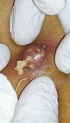 Dr Pimple POP on Instagram: "Follow us ?? @cyst.removal.videos for more pimple popping videos?? #pores #acne #skincare #blackheads #pimples #whiteheads #pimple #blackhead #skin #beauty #blackheadextraction #blackheadremoval #pimplepopping #whitehead #pimplepop #pimplepoppers"