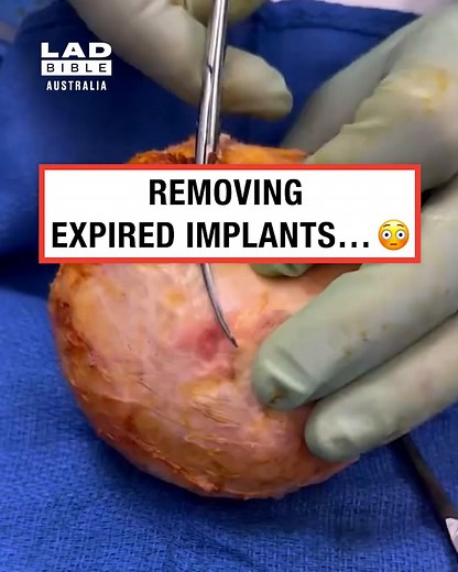 378K views · 420 reactions | They can expire  #implants #surgery #weird | LADbible Australia | Facebook